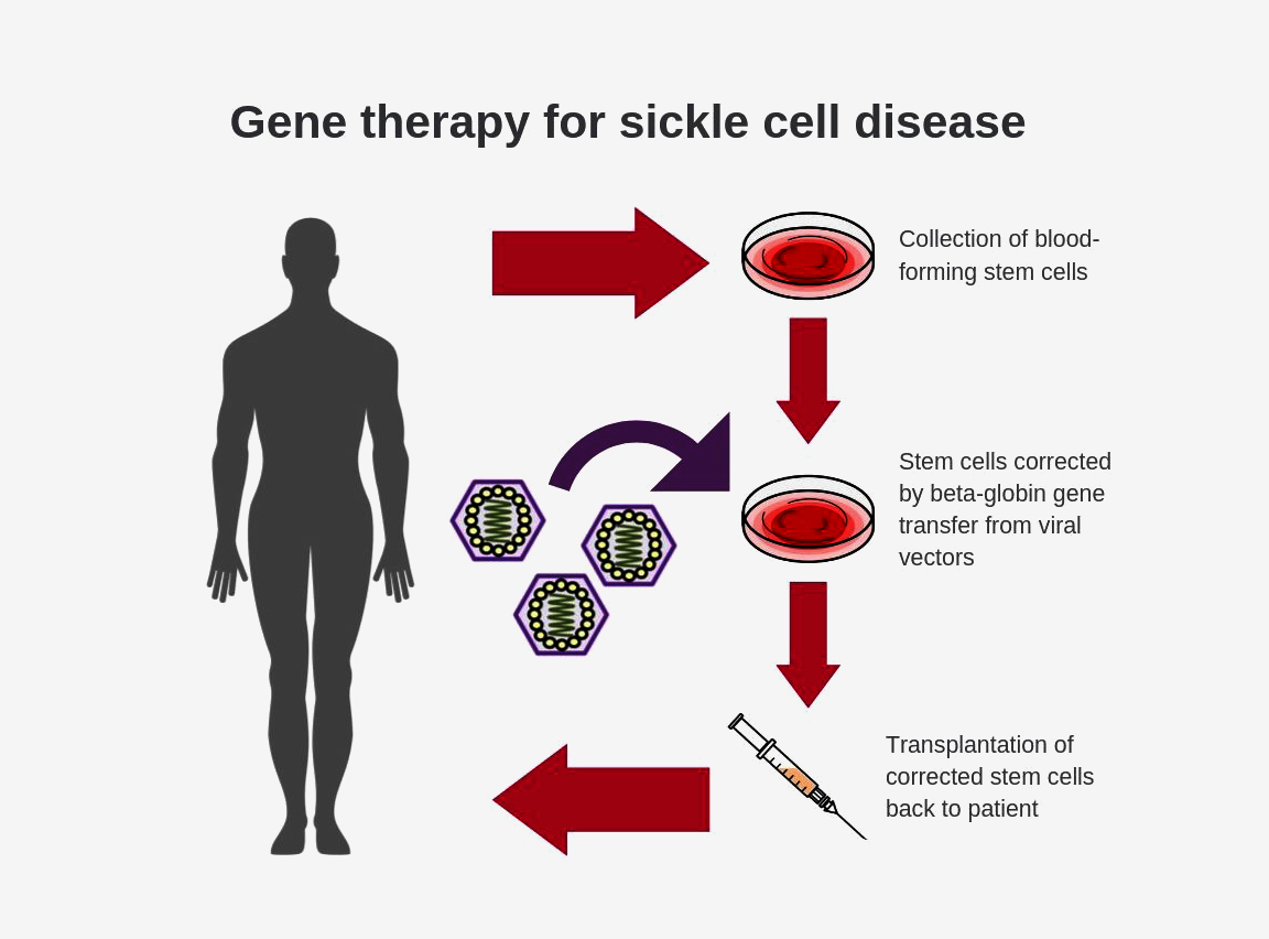 : Diagram shows steps for conducting gene therapy for sickle cell disease: Blood-forming stem cells are collected, stem cells are corrected by beta-globin gene transfer from viral vectors, and then corrected stem cells are transplanted into patient.