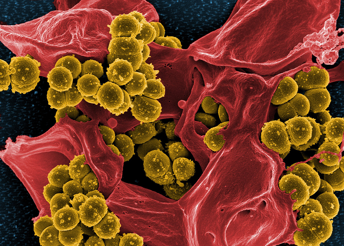 Methicillin-resistant Staphylococcus aureus bacteria (colored yellow) on a dead human white blood cell (colored red).
