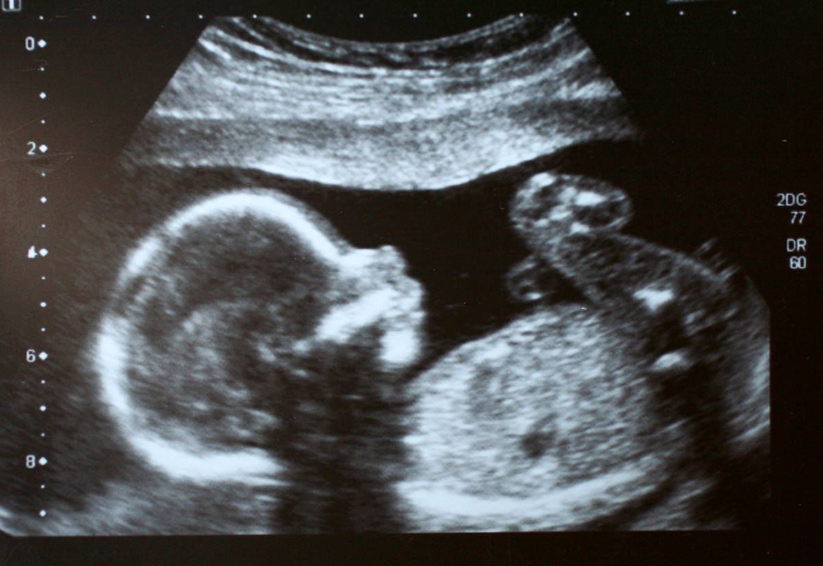 An ultrasound image of a fetus