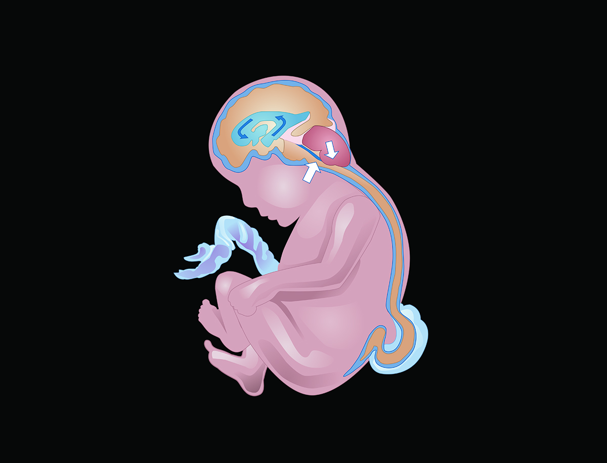 llustration of the spinal cord protrusion in myelomeningocele.