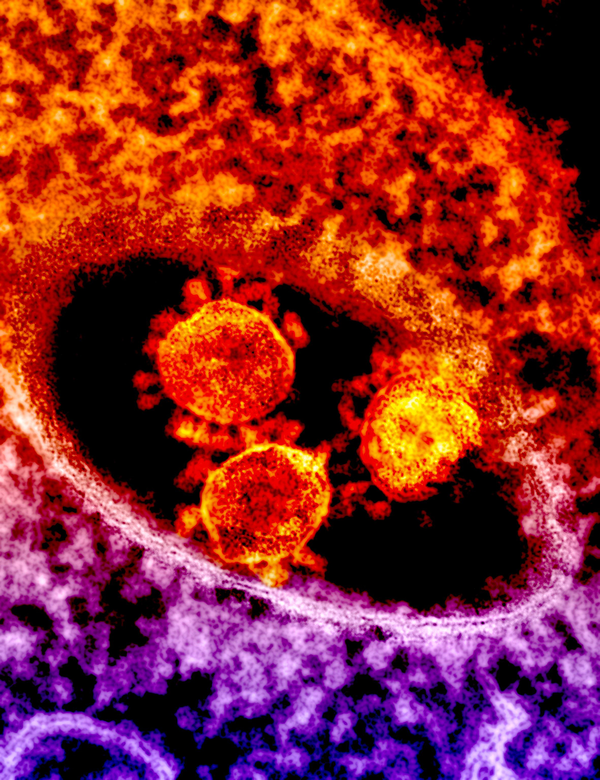 Electron micrograph showing particles of the MERS Coronavirus