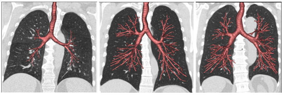 Image of CT scans of the lungs