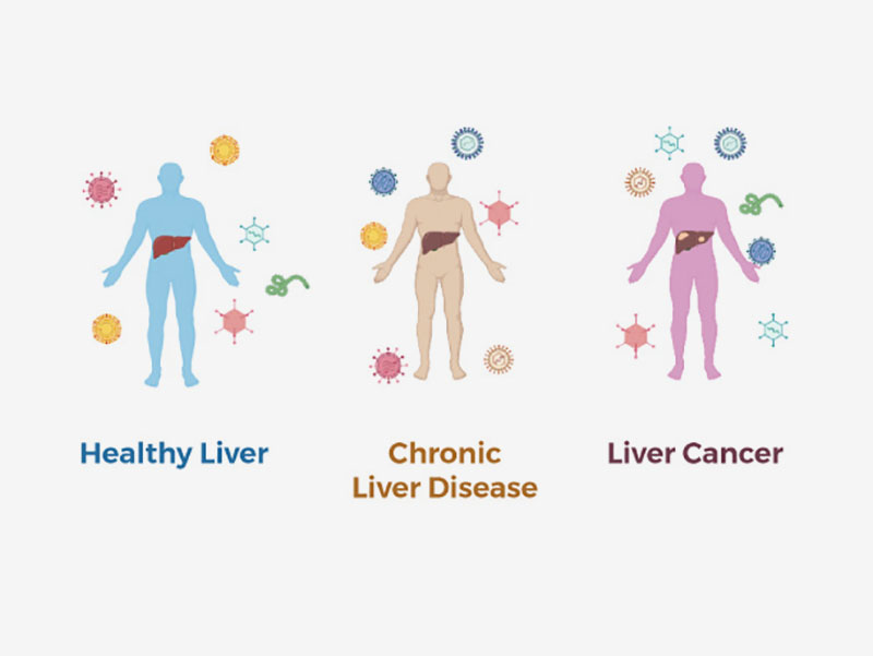 Illustration of different types of liver disesae