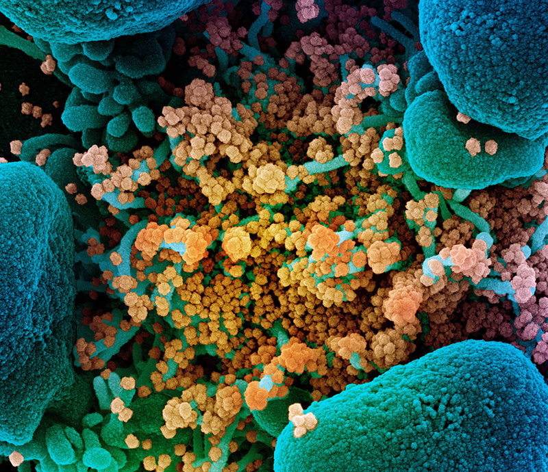 Colorized scanning electron micrograph of an apoptotic cell (blue) heavily infected with SARS-COV-2 virus particles (yellow), isolated from a patient sample.