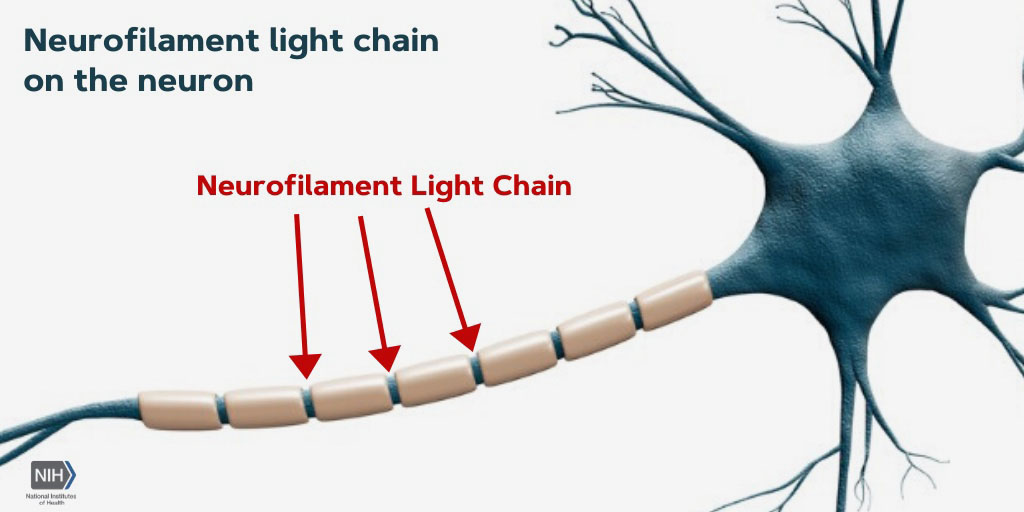 Illustration of neurofilament light chain