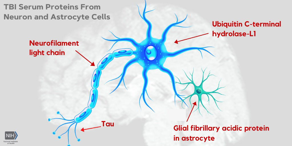 meget fint position Afledning NfL outperforms other blood tests to predict and diagnose traumatic brain  injury | National Institutes of Health (NIH)