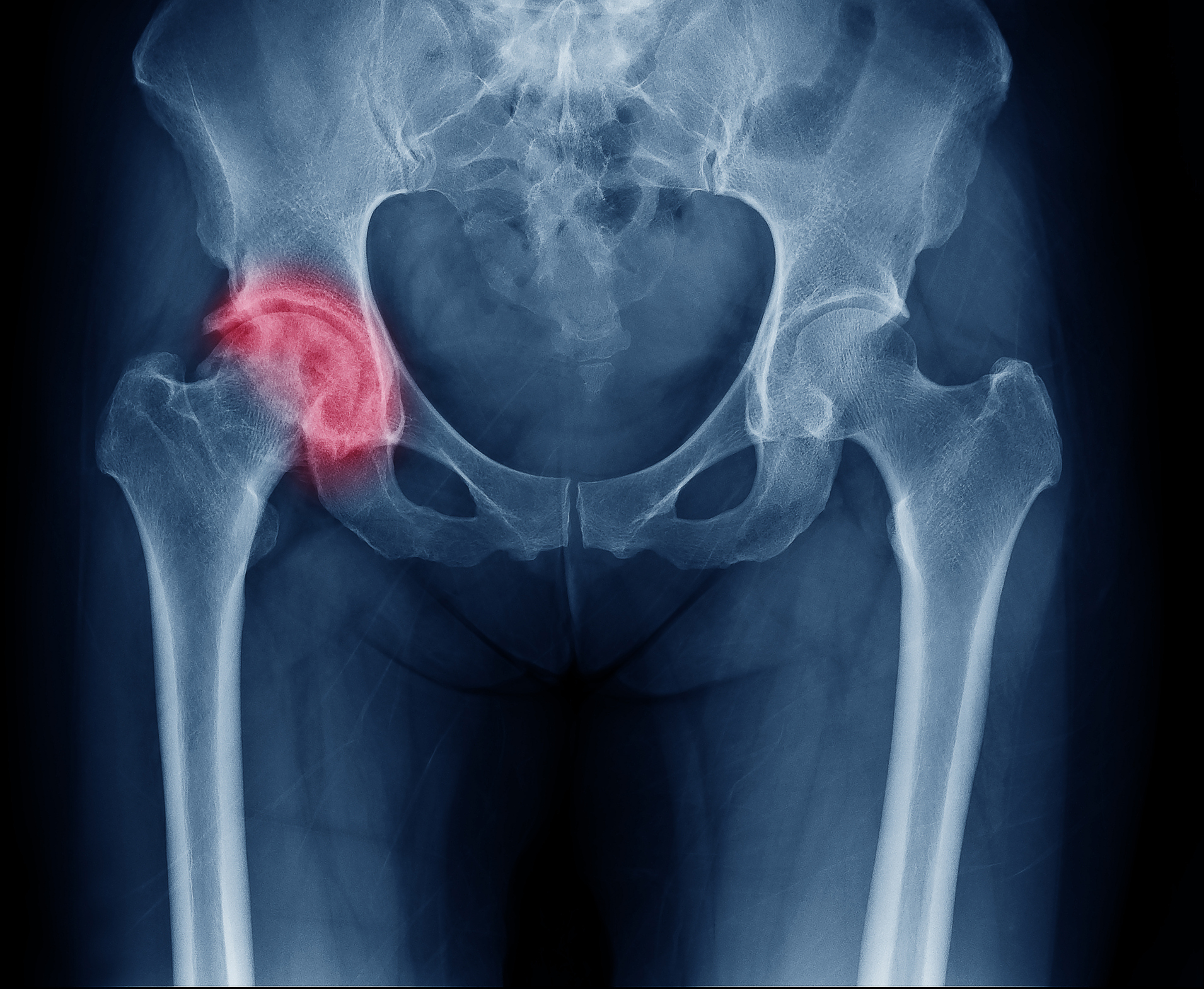 X-ray image of painful hip in woman present Osteoarthritis right hip joint at red area mark