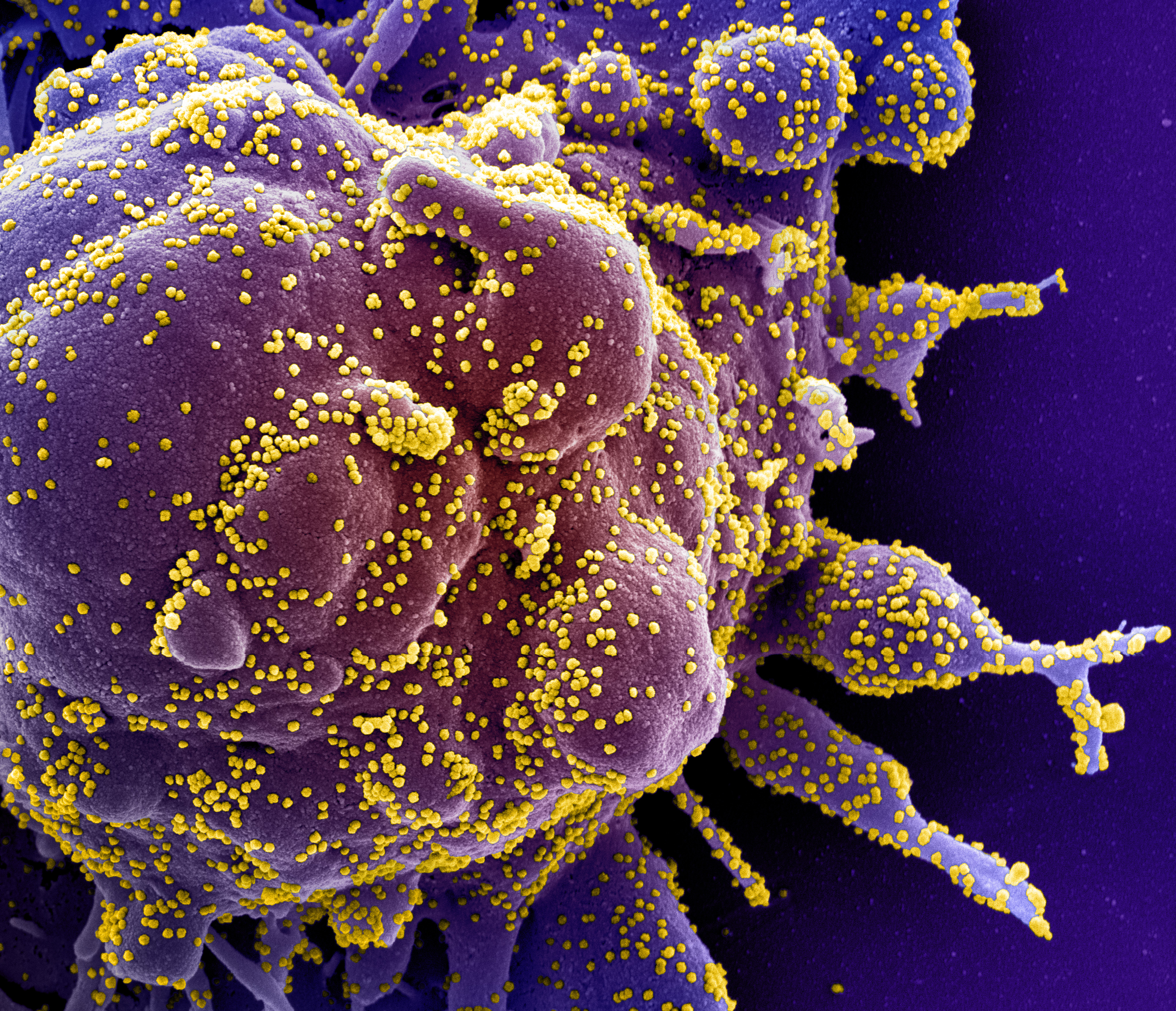 Colorized scanning electron micrograph of a cell (purple) infected with SARS-COV-2 virus particles