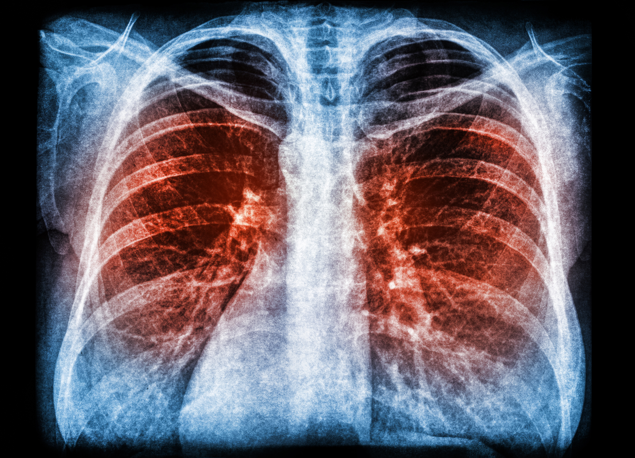 X-ray scan of pneumonia lung infection