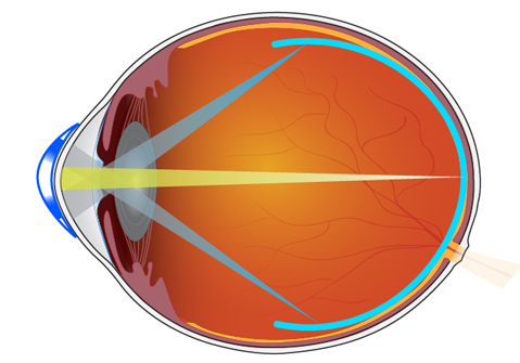 Illustration of multifocal contact lenses