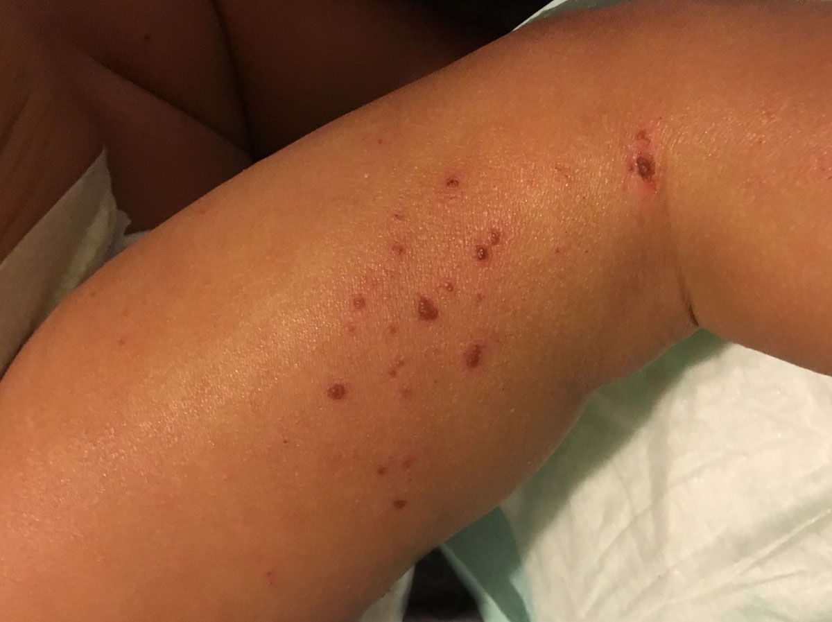 NIH-Supported Scientists Demonstrate How Genetic Variations Cause Eczema |  National Institutes of Health (NIH)