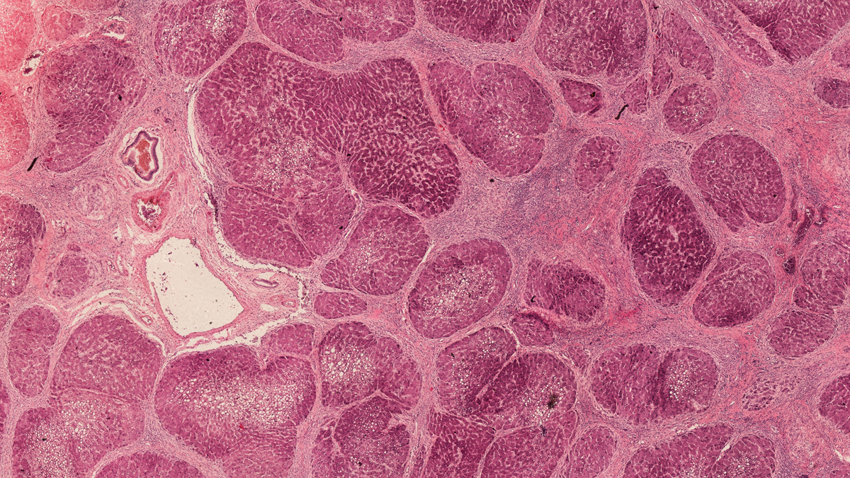 cross section cut of liver cirrhosis under the microscope