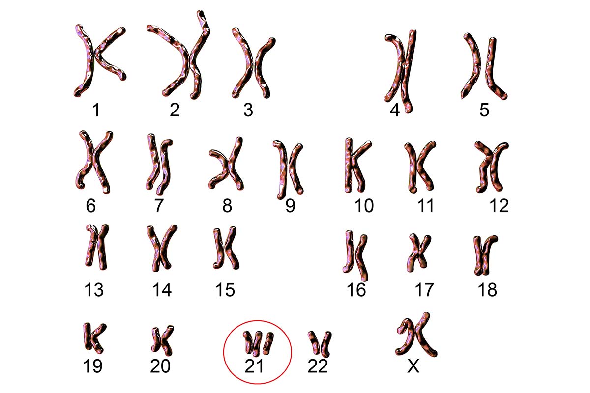 A chart of human chromosomes showing the extra 21st chromosome present in Down syndrome