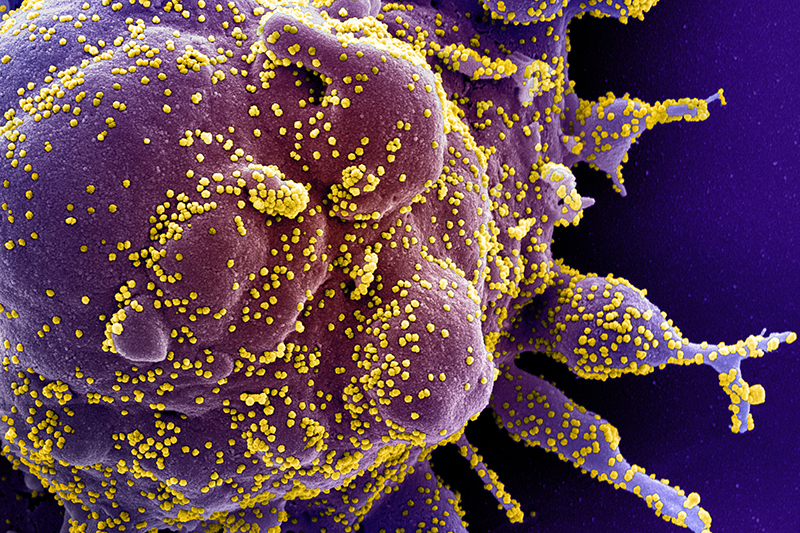 Colorized scanning electron micrograph of an apoptotic cell (purple) heavily infected with SARS-COV-2 virus particles (yellow), isolated from a patient sample.