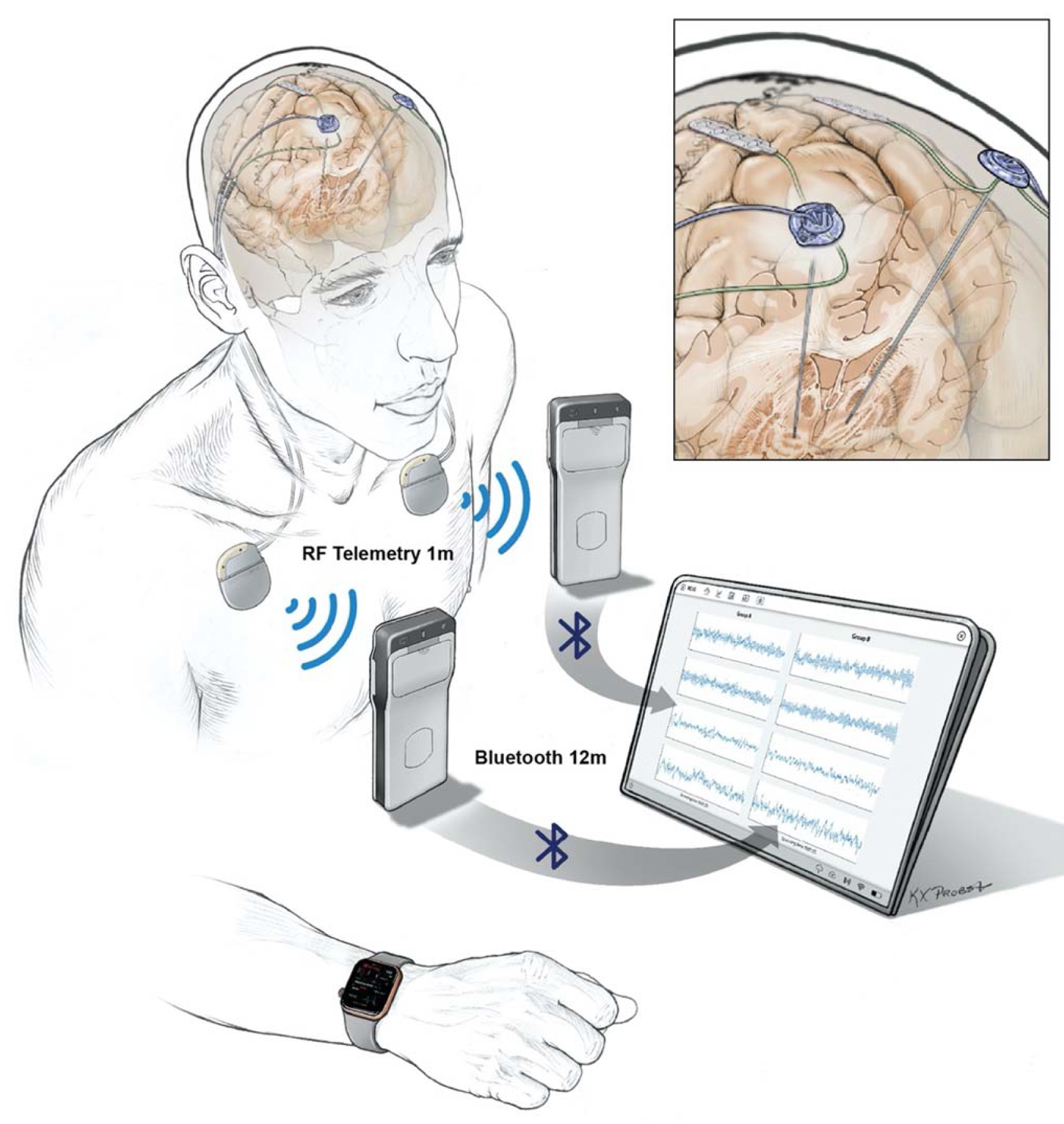 Implanted electrodes stream recorded data to a pocket-sized device worn by a patient