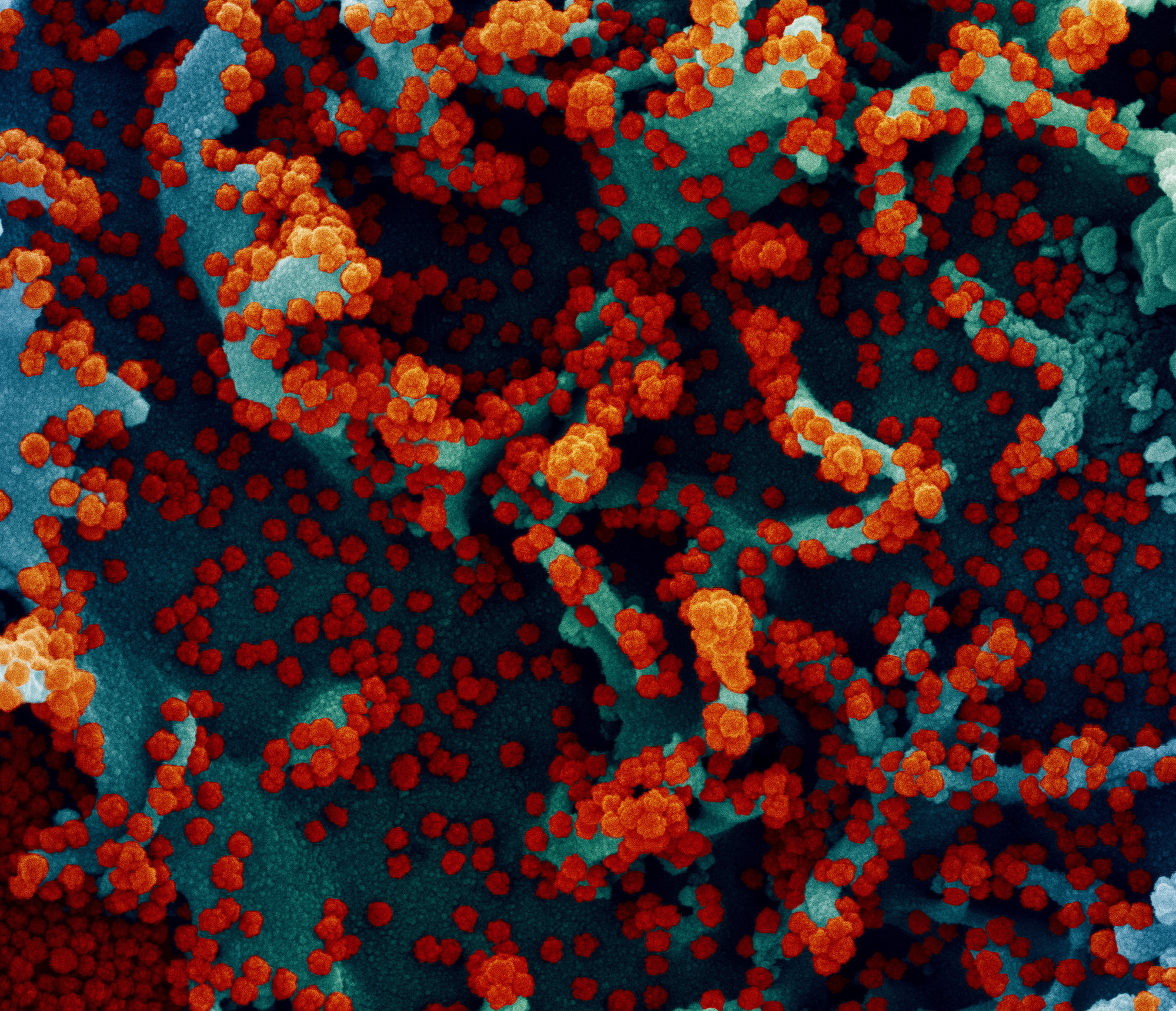 Colorized scanning electron micrograph of a human cell heavily infected with SARS-CoV-2 virus particles (red). 