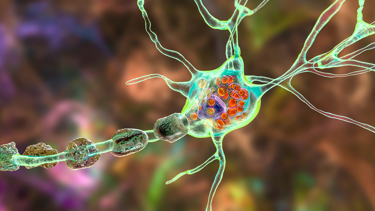 3D illustration showing swollen neurons with lamellar inclusions due to accumulation of gangliosides in lysosomes