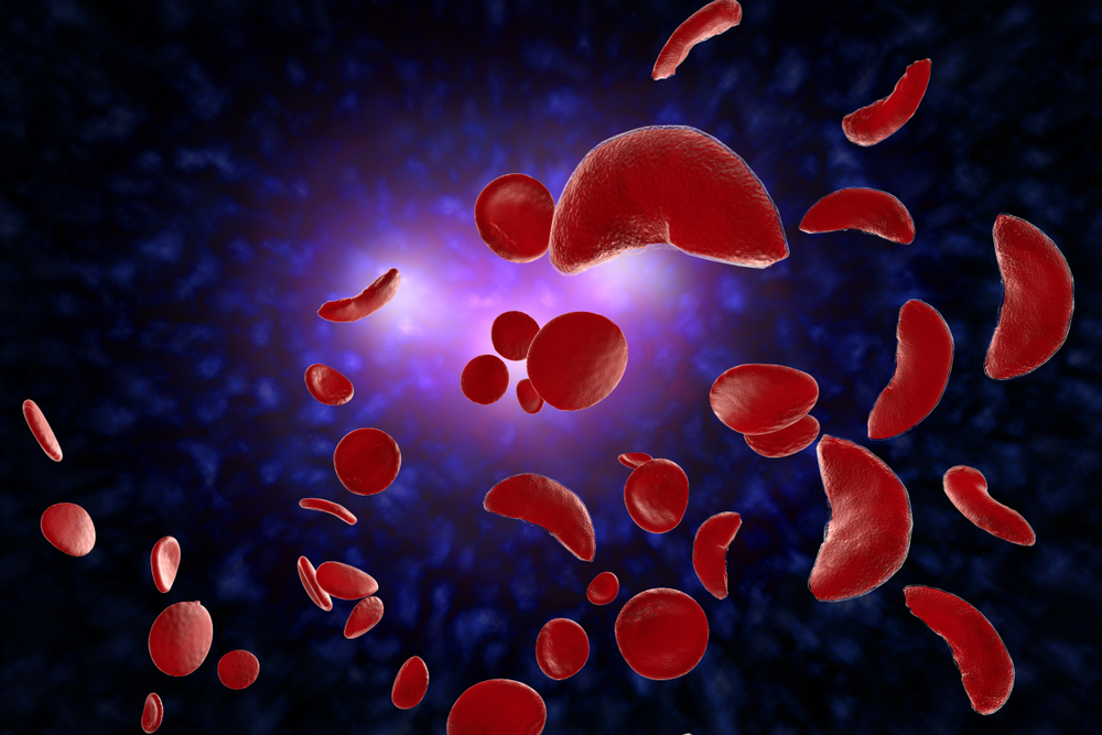 Sickle cell anemia disease (SCD) blood cells 3D