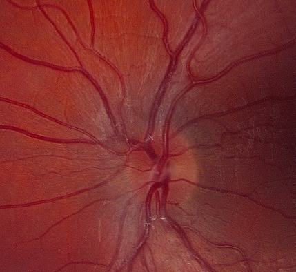 Image of diseased and normal optic nerve heads