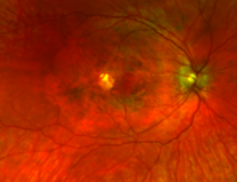 Retinal images of a patient with a TIMP3 mutation causing atypical symptoms. While there is visible damage in the retina (dark circles), there is no CNV present. 