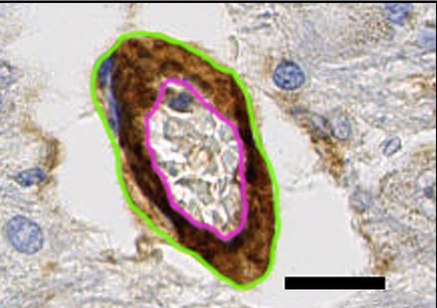 Small NIH study reveals how immune response triggered by Covid may damage brain