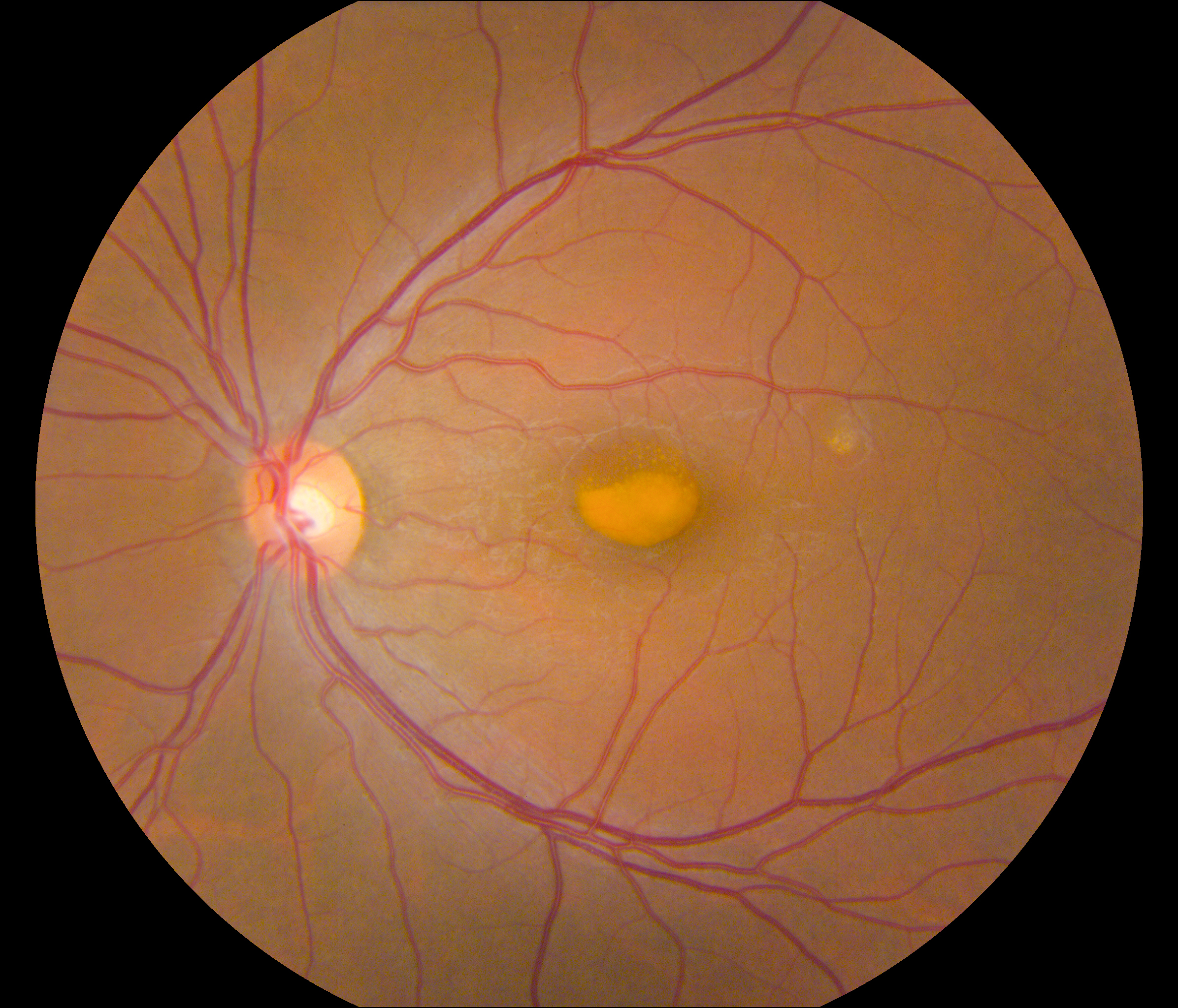 Image of a retina in a person with VMD