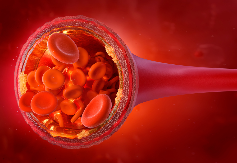 Normal level of LDL cholesterol in the arteries. Atherosclerosis disease initial stage 3D illustration: atherosclerotic plaques, red blood cells. Cholesterol in the blood vessels, risk of thrombosis