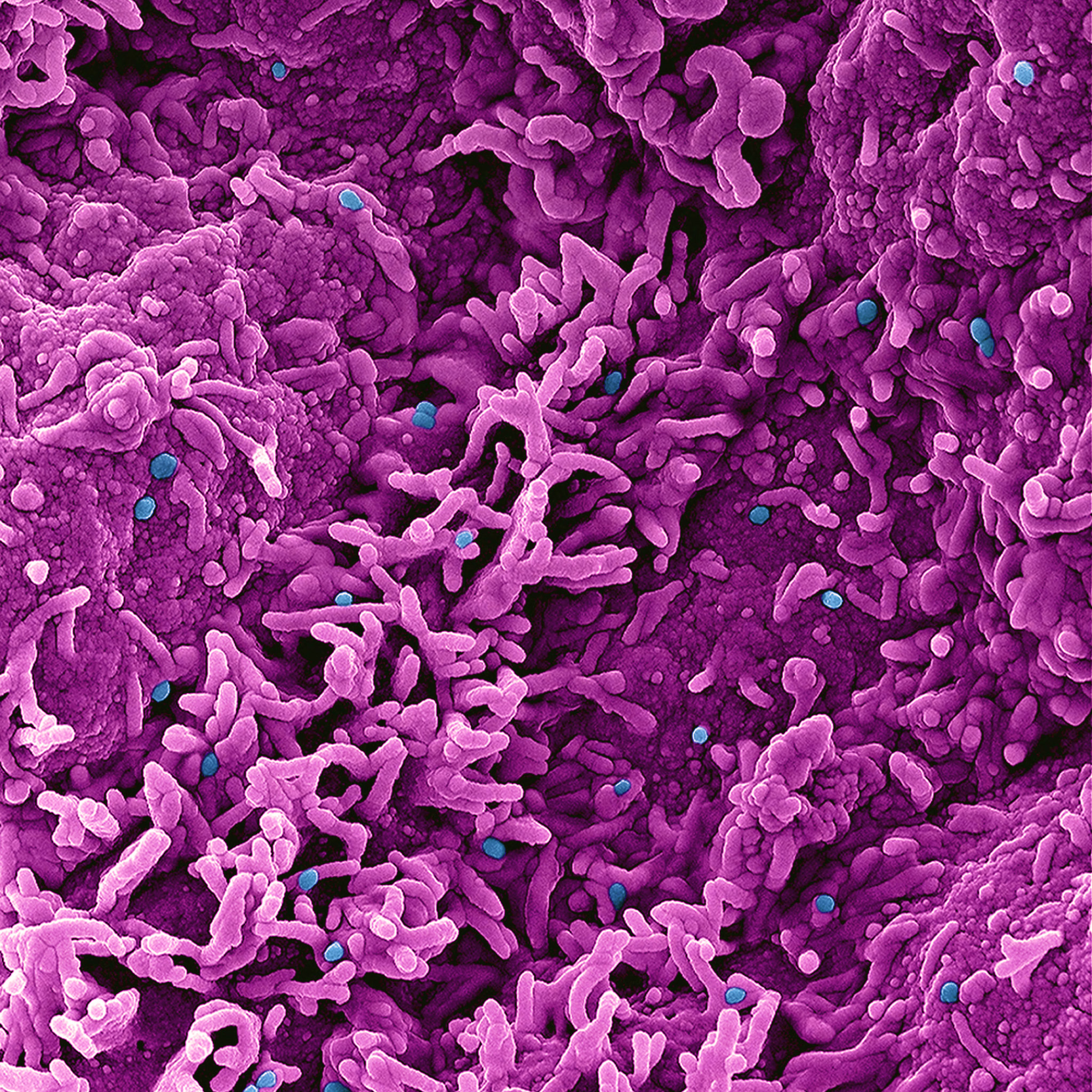 Monkeypox Virus Colorized scanning electron micrograph of monkeypox virus (blue) on the surface of infected VERO E6 cells (pink). Monkeypox Virus Colorized scanning electron micrograph of monkeypox virus (blue) on the surface of infected VERO E6 cells (pink).