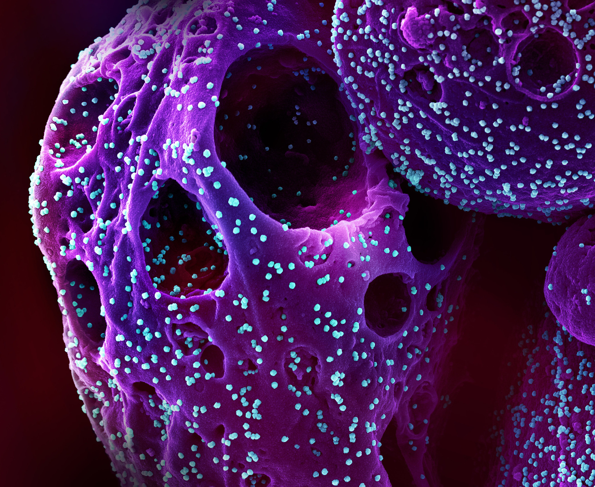 NIH RECOVER research identifies potential long COVID disparities