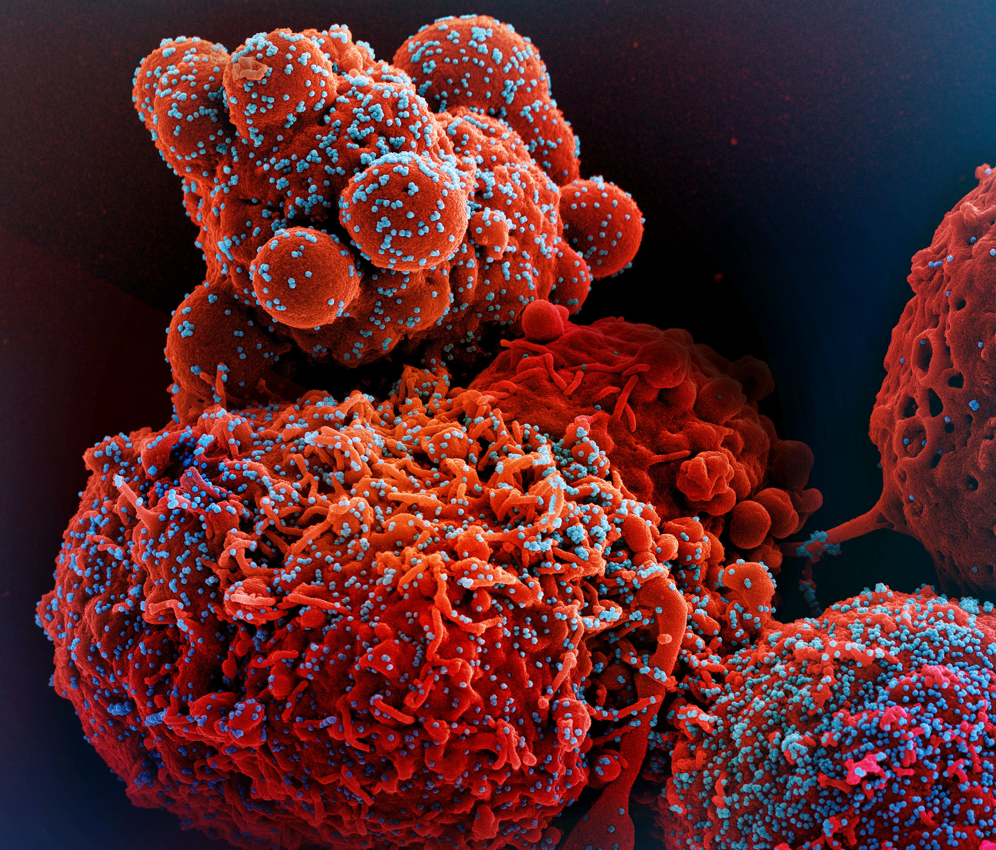 Colorized scanning electron micrograph of a cell (red) infected with the Omicron strain of SARS-CoV-2 virus particles (blue), isolated from a patient sample.