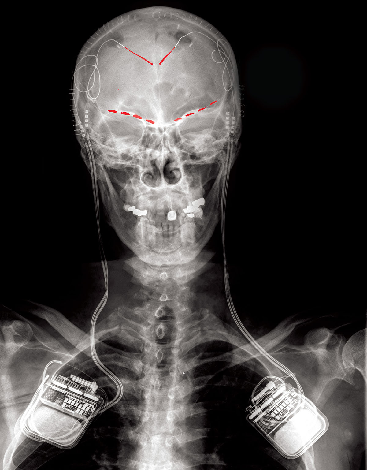 X-ray image of electrode brain implants X-ray image of electrode brain implants