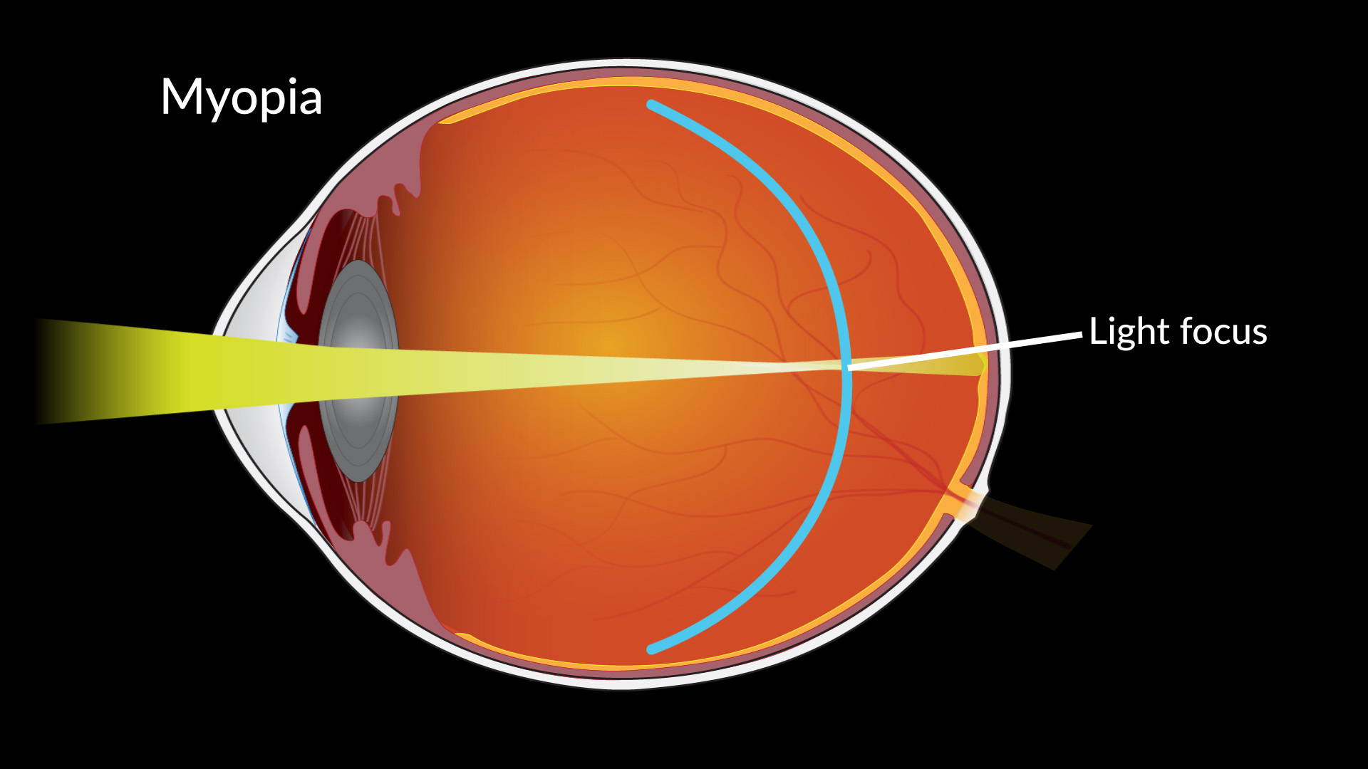 Diagram of an eye with myopia
