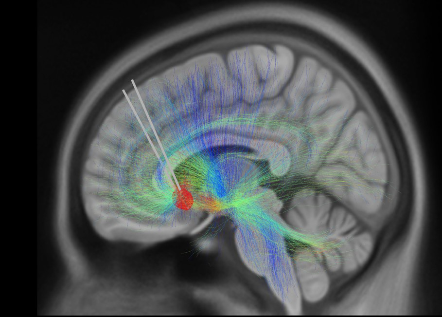MRI scan of a brain with an implanted DBS device. MRI scan of a brain with an implanted DBS device.