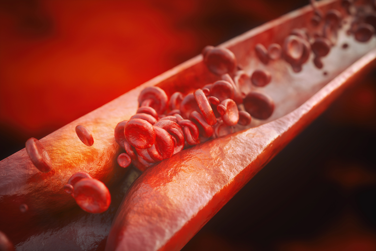 medical illustration of arterial plaque