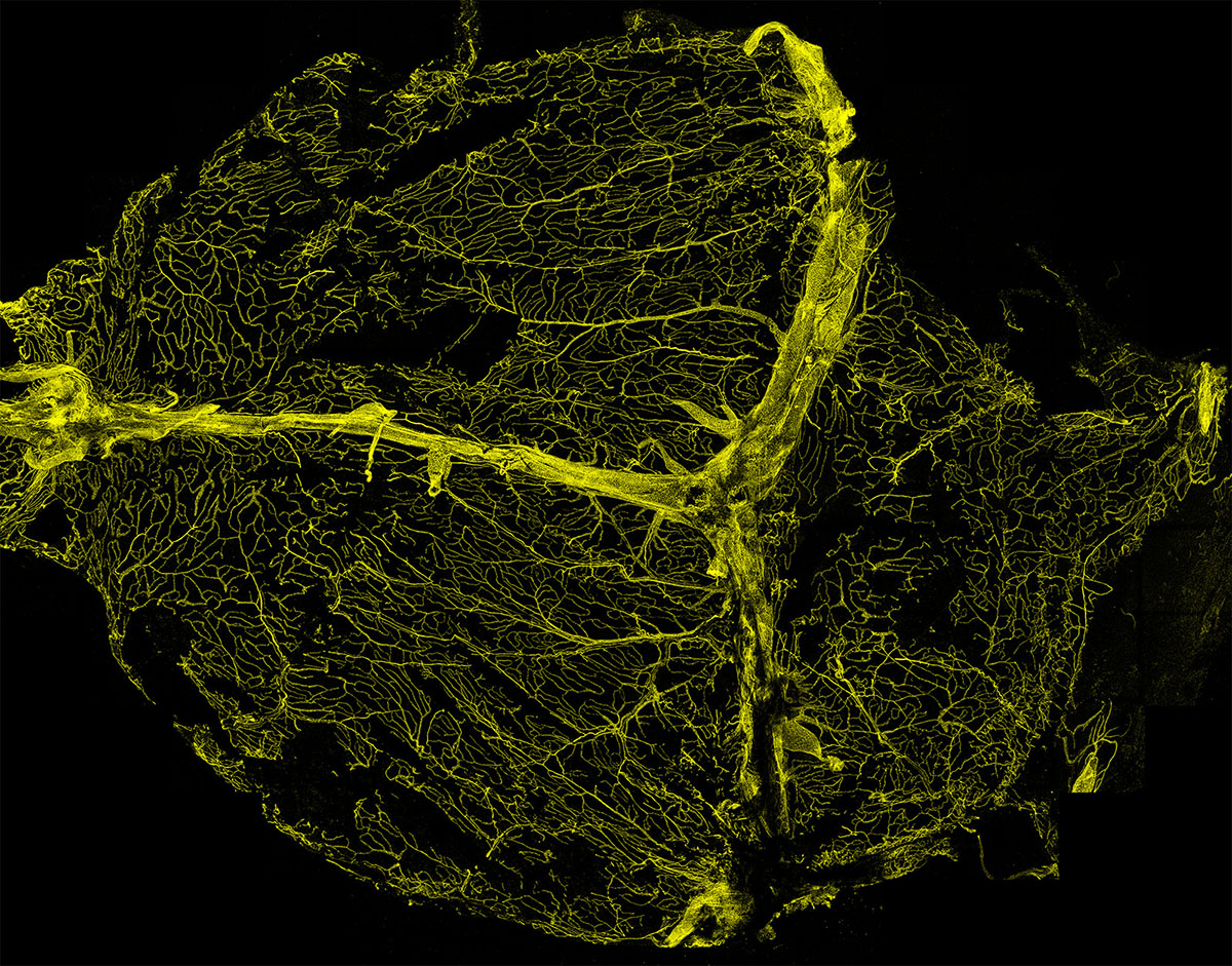 Salty Immune Cells Surrounding the Brain: A Link to Hypertension-Induced Dementia