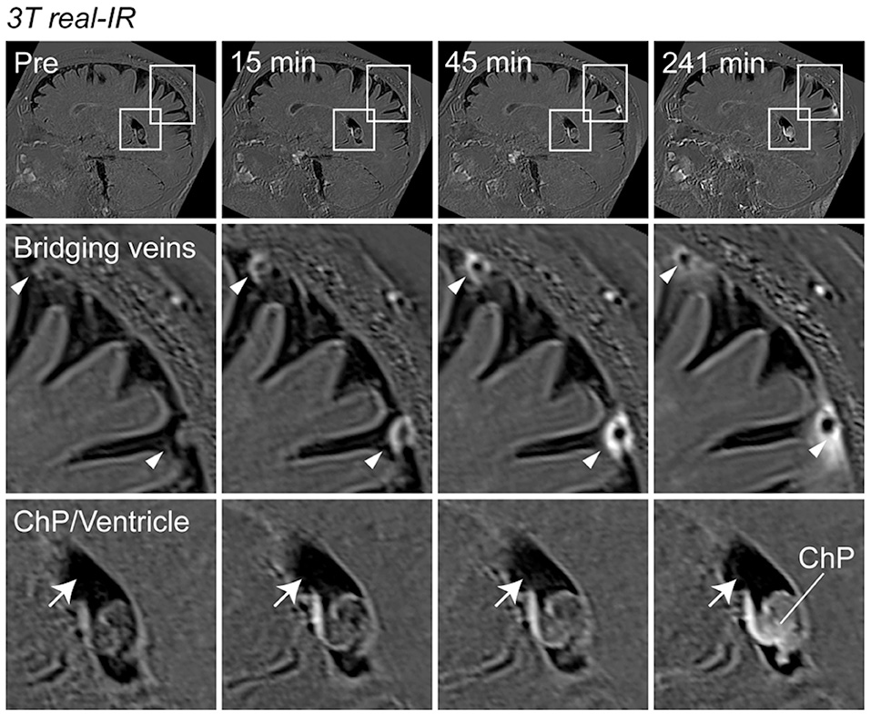 A series of MRI images showing the movement of light-emitting molecules moving through the arachnoid barrier. 