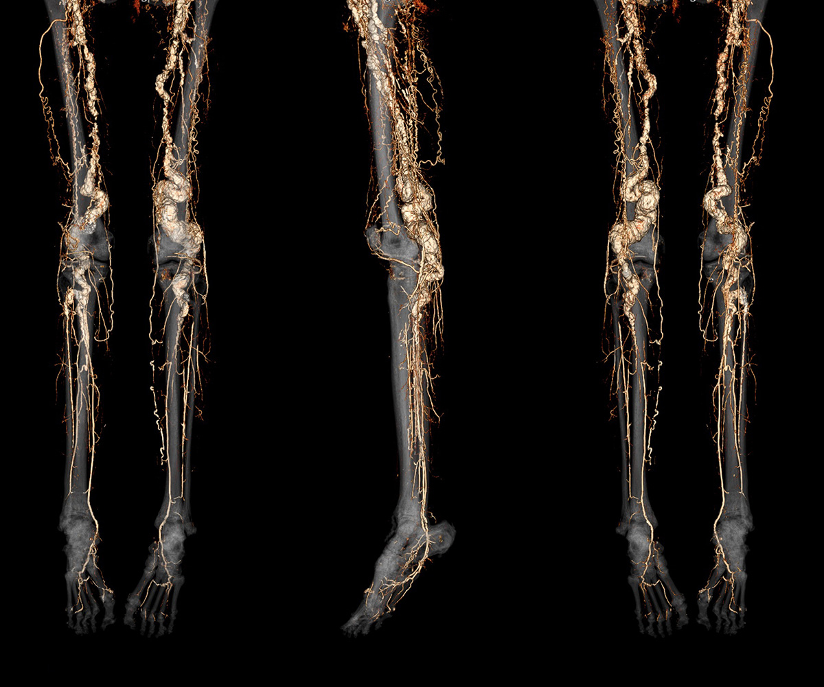 A CT angiography scan of a person with ACDC disease showing abnormal calcification of the blood vessels in the legs and feet. 