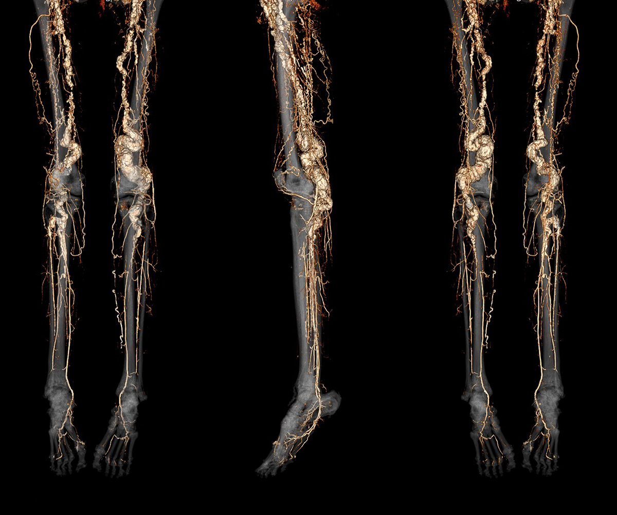 A CT angiography scan of a person with ACDC disease showing abnormal calcification of the blood vessels in the legs and feet. A CT angiography scan of a person with ACDC disease showing abnormal calcification of the blood vessels in the legs and feet.