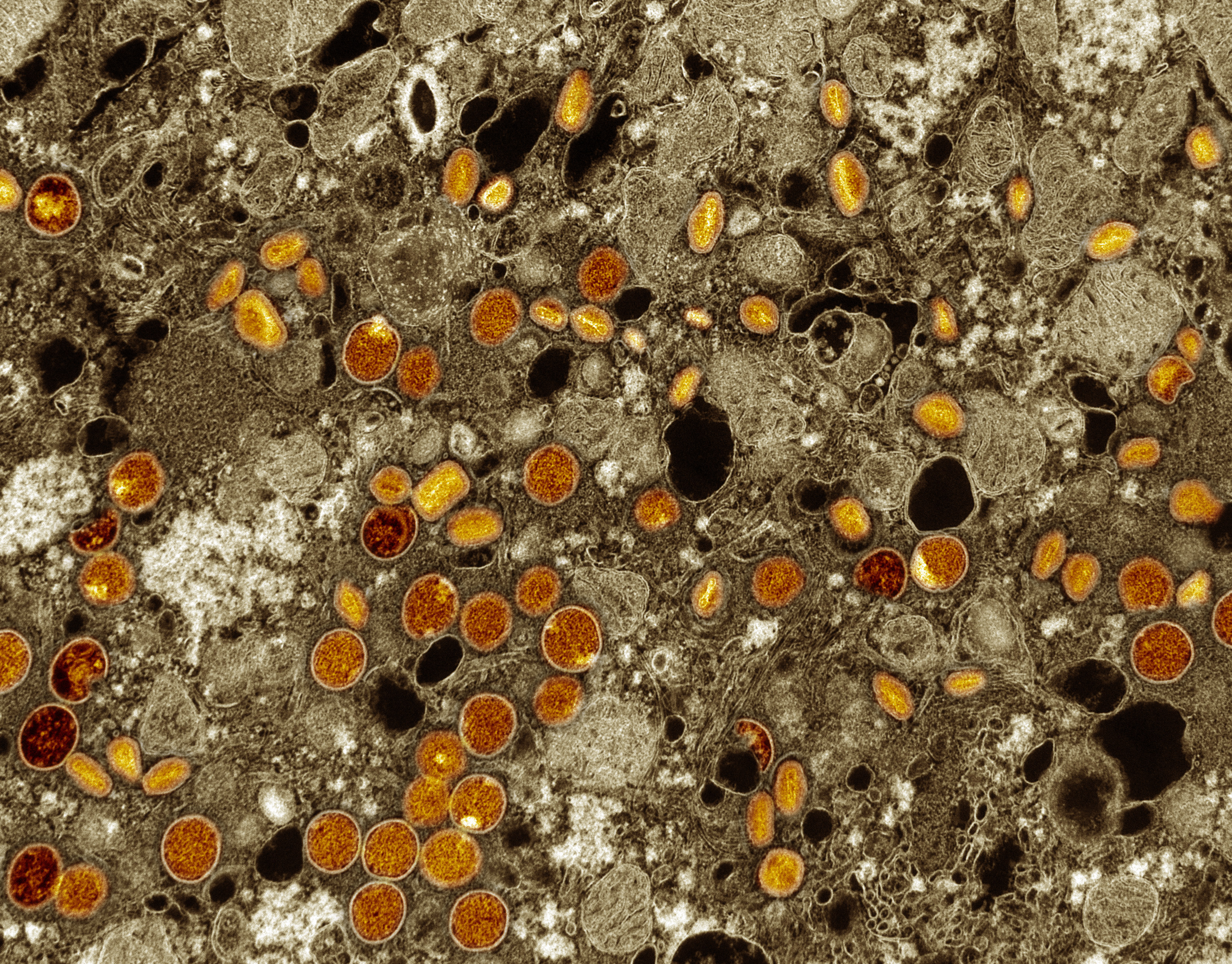 The antiviral tecovirimat is safe but did not improve clade I mpox resolution in Democratic Republic of the Congo