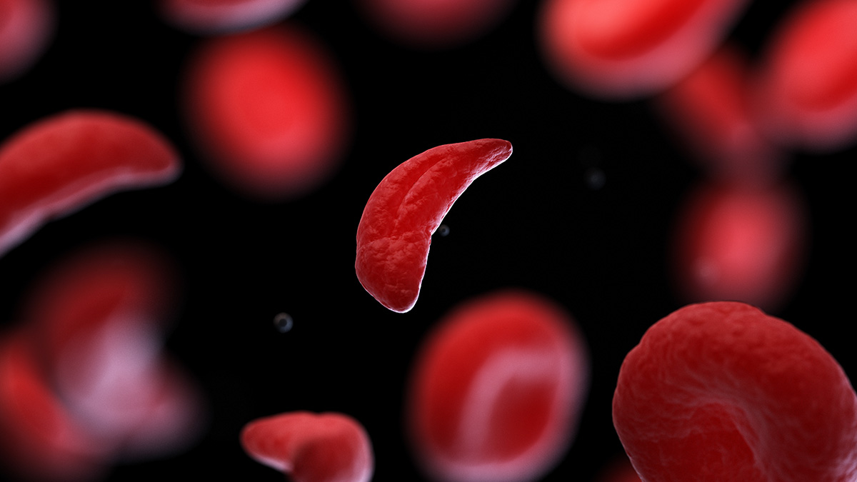 ‘Low-intensity’ blood stem cell transplants for sickle cell appear safe for lung health