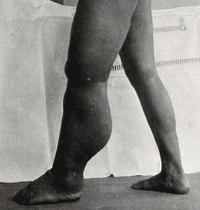 parazita elephantiasis