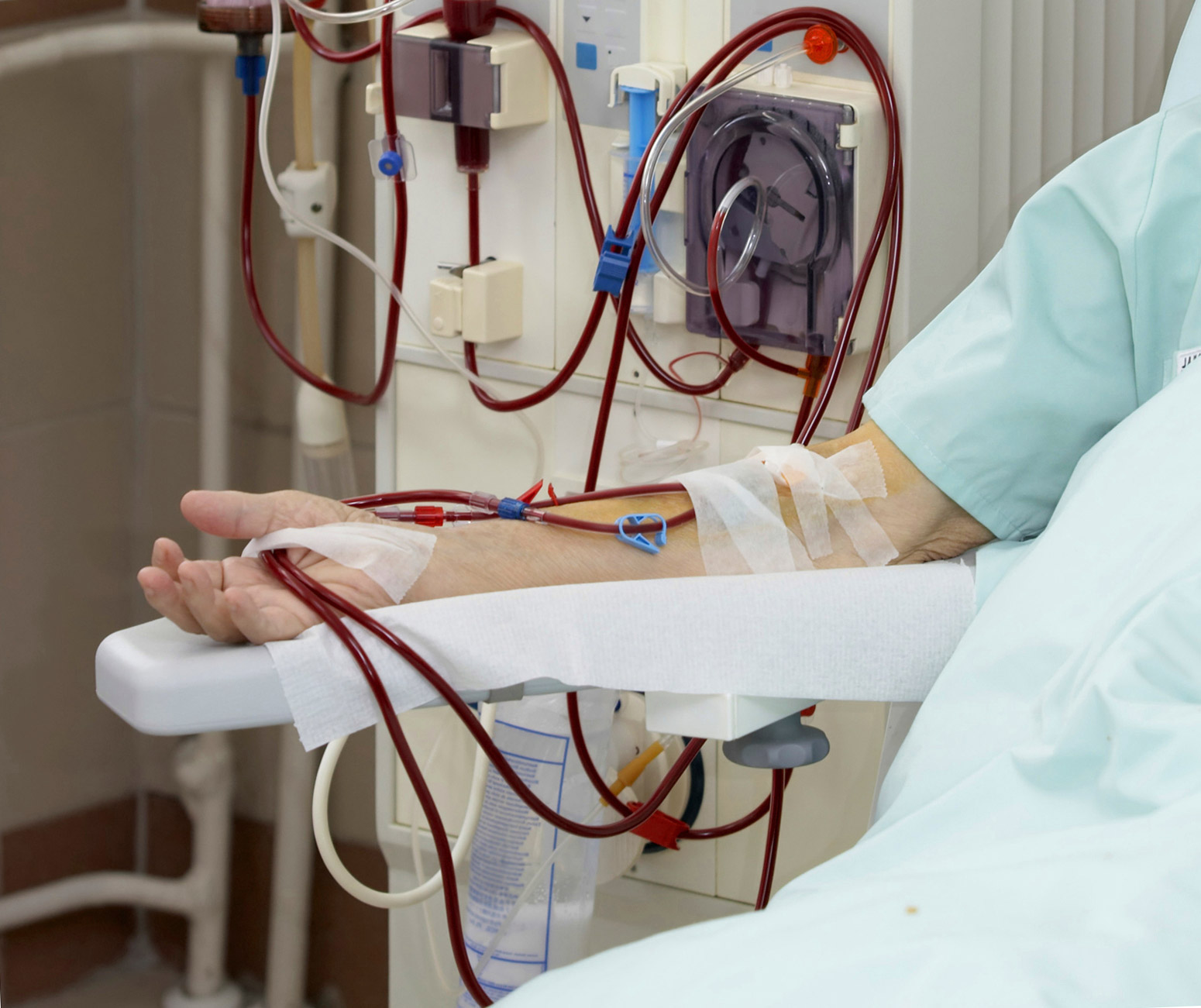 research studies related to dialysis