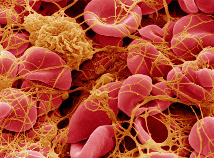 Image of clotted blood cells Image of clotted blood cells