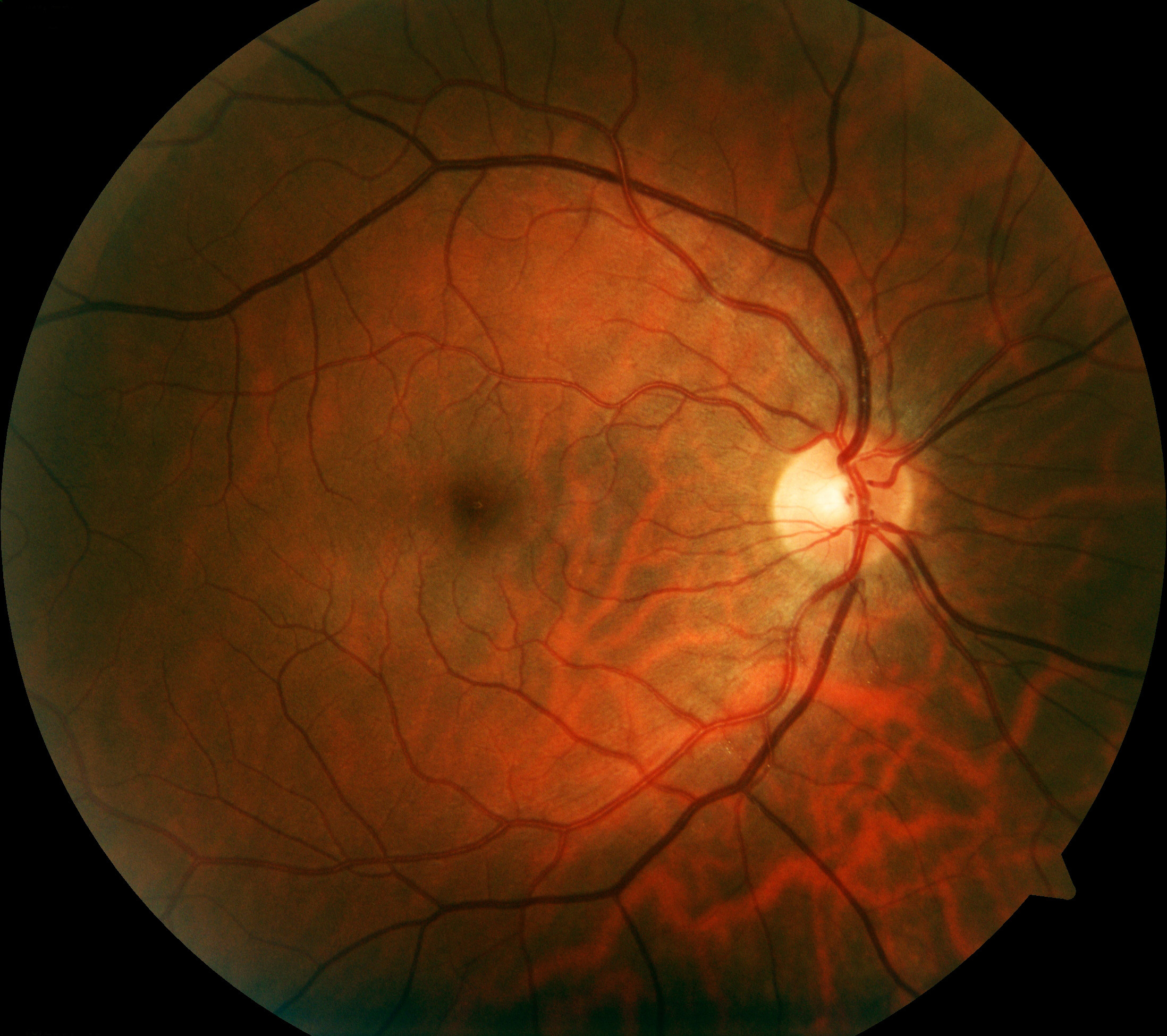 Mending Vision in Patients with Eye Vein Clots