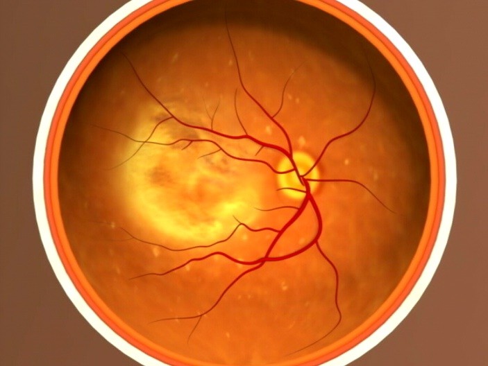 Illustration of an eye with AMD deposits