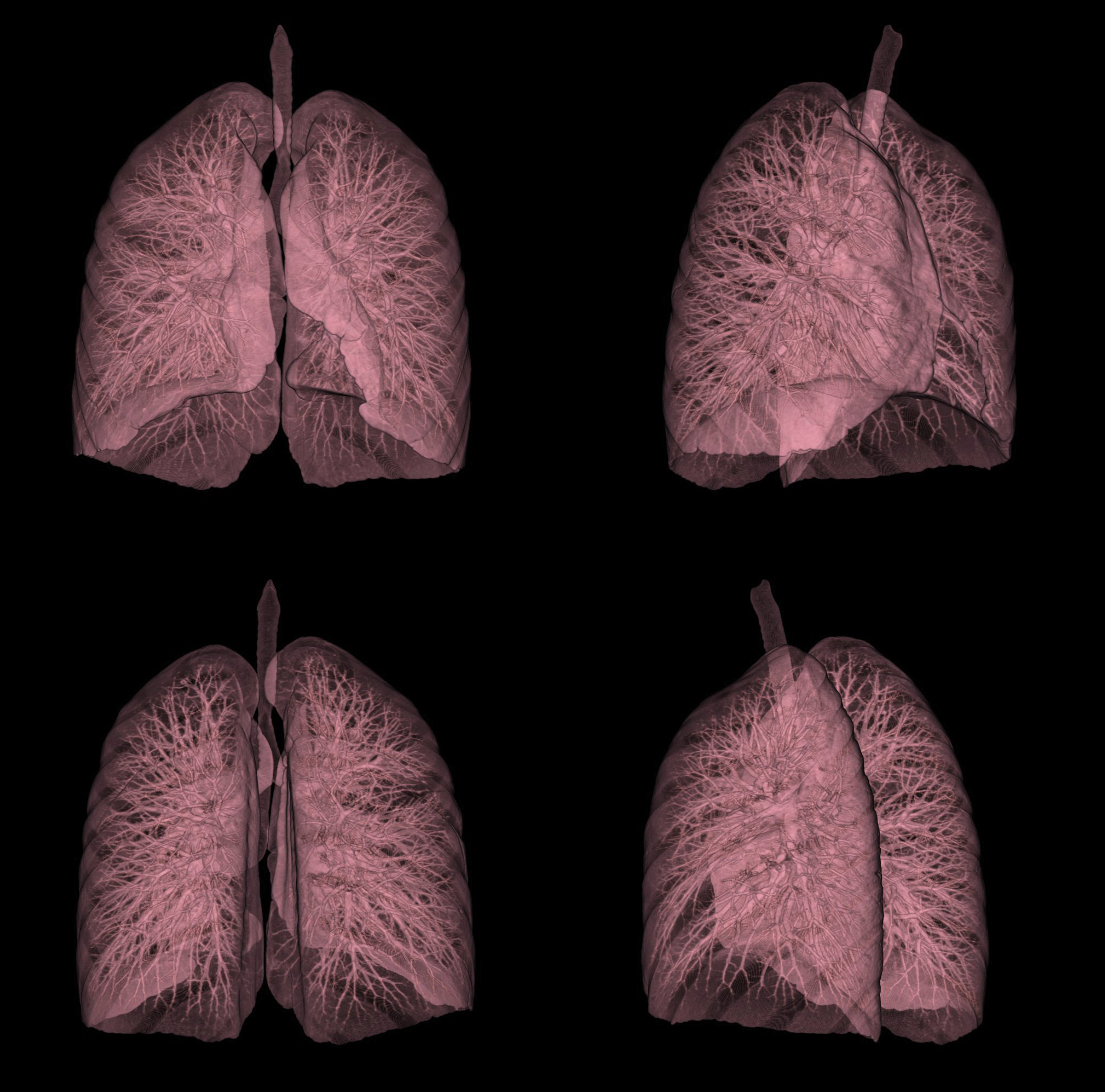 staging for mesothelioma