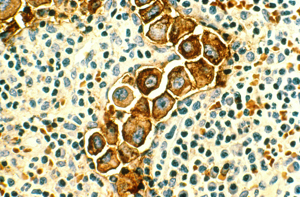 Microscopic image of a cluster of large cancer cells among smaller cells