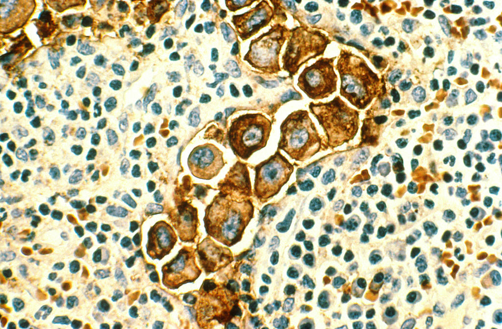 Microscopic image of a cluster of large cancer cells among smaller cells Microscopic image of a cluster of large cancer cells among smaller cells
