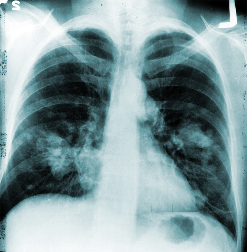 Annual Chest Xrays Don’t Cut Lung Cancer Deaths