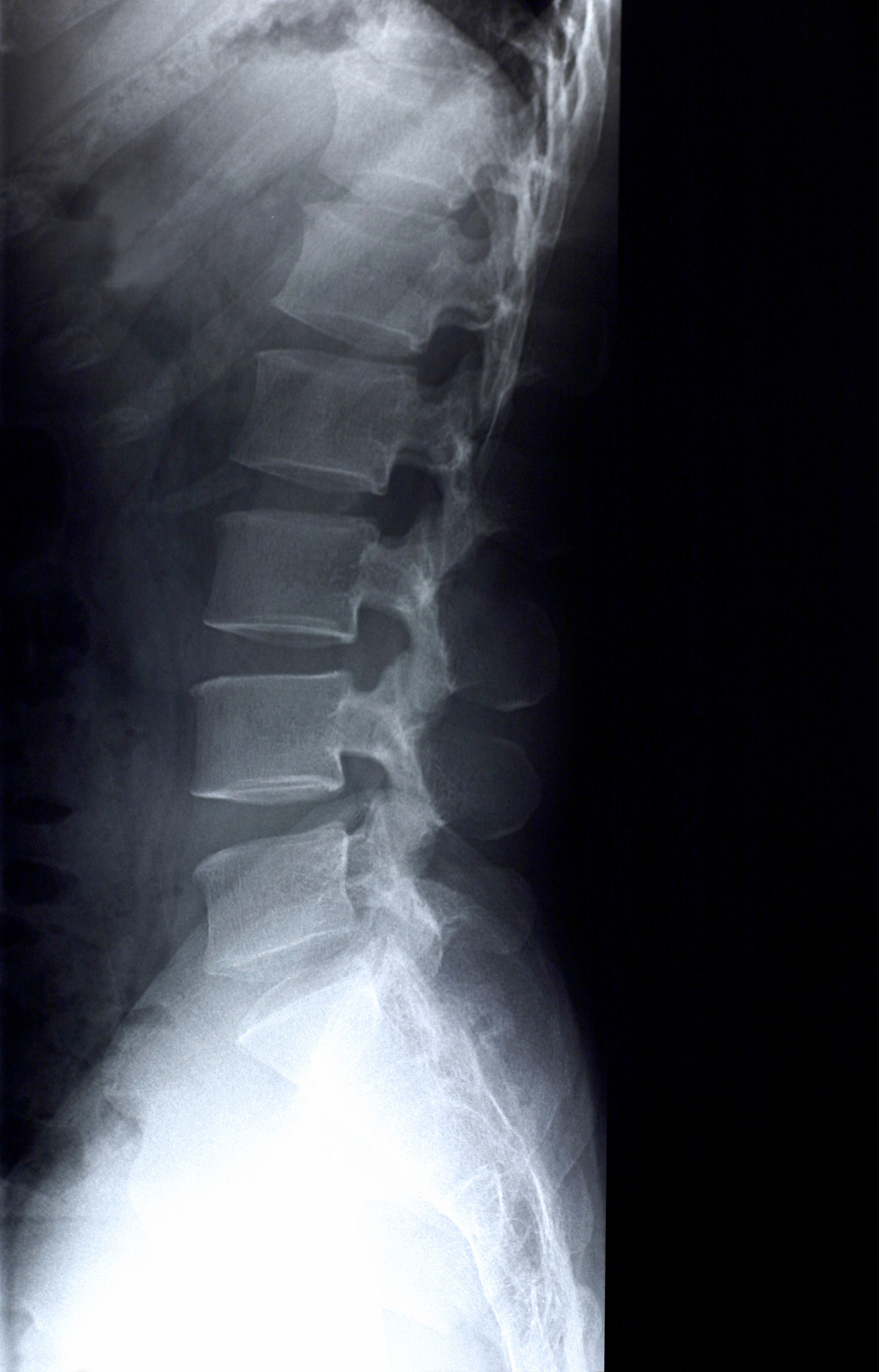 Genetics of Bone Density | National Institutes of Health (NIH)